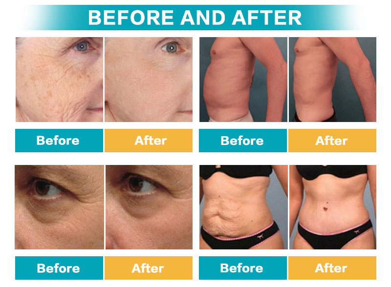 Fat Loss HIFU Slimming Machine Ultra 9D Face Lift Skin Tightening