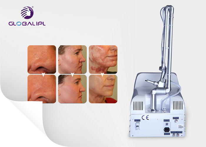 Portable Acne Removal Co2 Fractional Laser Equipment 50w Power Skin Whitening Device