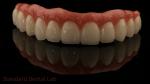 Hybrid Titanium Screw Retained Dental Implant Crown All On 4 Dental Implant
