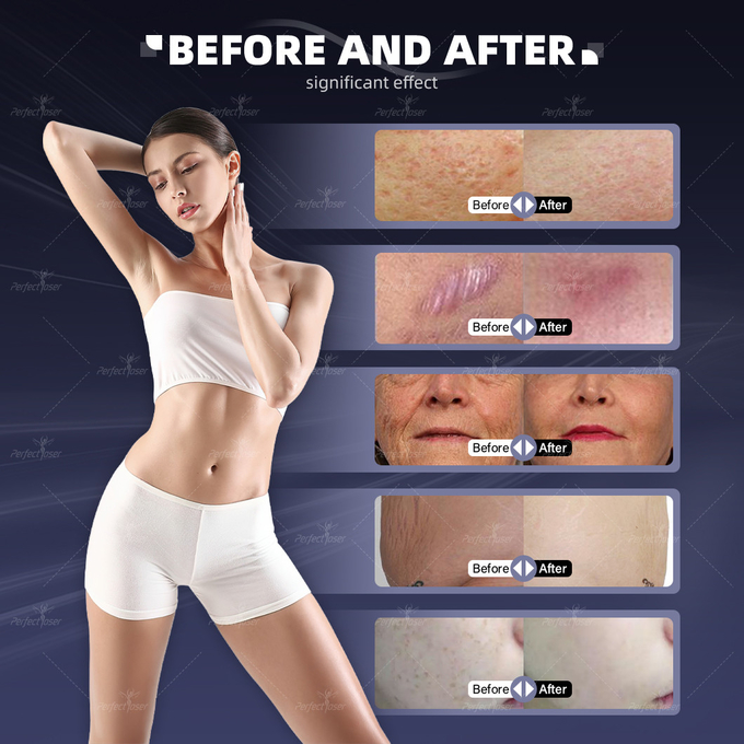 RF Tube 60W Big Power Fractional Co2 Laser Stretch-Mark Removal Skin Resurfacing Bring Youth Back