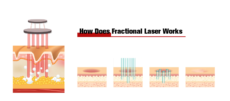 Skin Rejuvenation CO2 Fractional Laser Machine Beauty Pigment Treatment