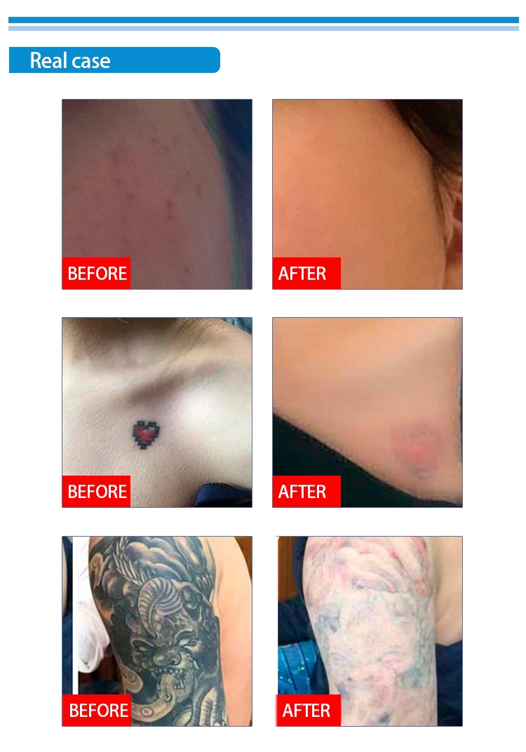 Nd Yag Pico Laser Tattoo Removal , Laser Resurfacing Machines 1064nm