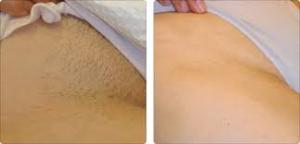 China Profession hair removal portable 808nm diode laser hair removal machine wholesale