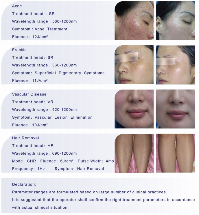Monaliza Sincoheren IPL&SHR fast hair removal skin rejuvenation pore remover dark circles