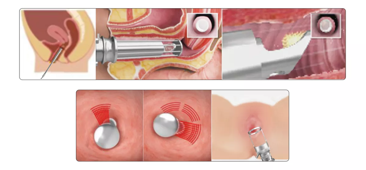 40W RF Metal Tube CO2 Fractional Laser Fractional CO2 Laser Machine For Scars Skin Resurfacing Vaginal Tightening
