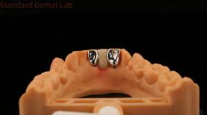 China Dental PFM Maryland Bridge High Esthetics FDA Certified With Vita Porcelian China Dental Lab wholesale
