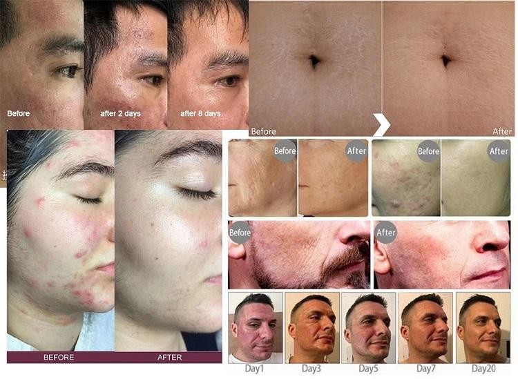 2 Handle Nano RF Microneedling Machine Acne Scar Removal Laser Machine