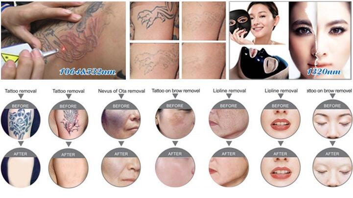 Professional Q-switched Nd yag laser tattoo removal machine with low price