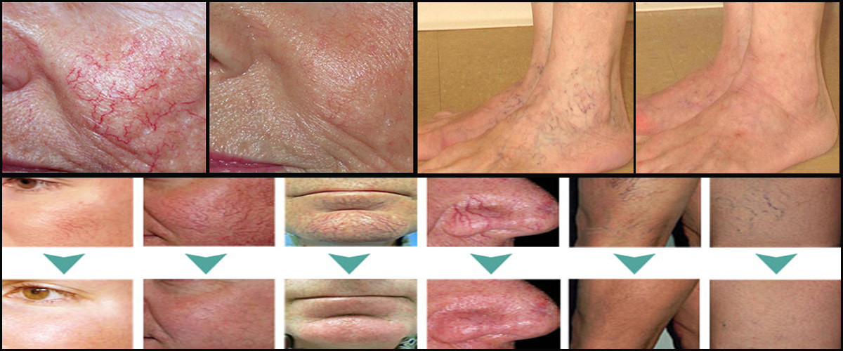 Spider vein laser removal treatment vascular removal mach Laser varicose vein removal