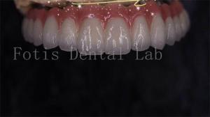 China Modern Seamless Integration Implant Retained Crown Easy To Clean wholesale
