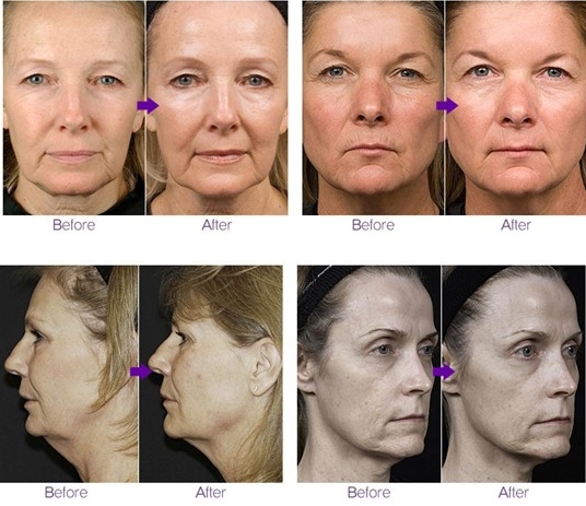 best results rf treatments for face with 0.5-3mm invasive microneedle
