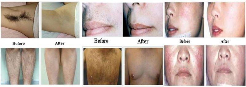 strong power painless portable 808nm diode laser hair removal device for salon use