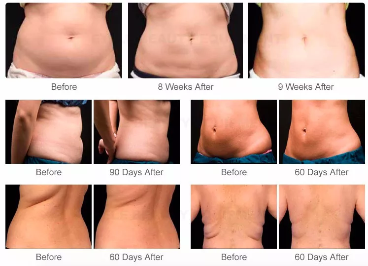 Vacuum Cavitation System Fat Burner Cavitation Machine 6 IN 1 Weight Loss Fat Reduction, Body EMShape Machine