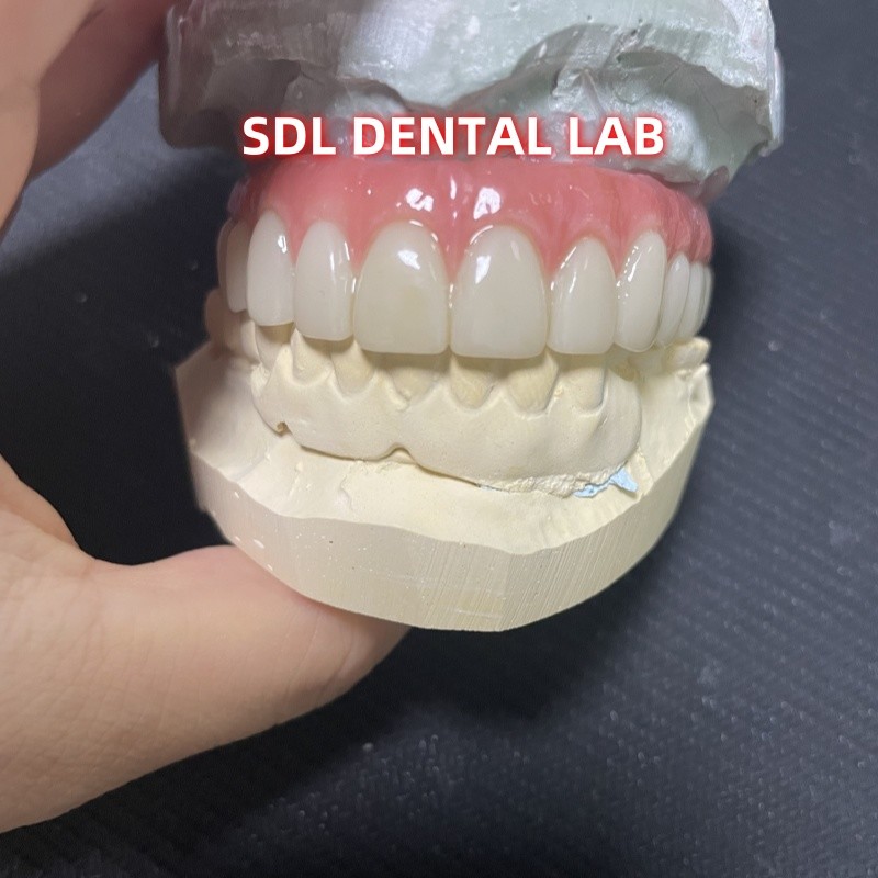 All On Four Six Ivoclar Zirconia Implant Bridge TItanium Bar With Pink Gum Porcelain