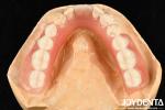 Diverse And Lightweight Resin Material Acrylic Denture Finish
