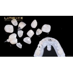 Ultra-thin aesthetic dental veneers