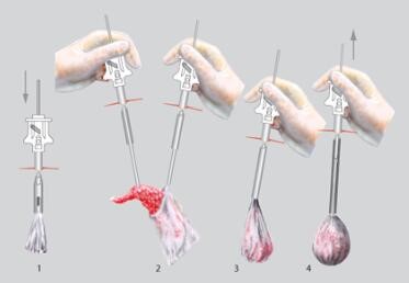 150mmx100mm TPU Laparoscopic Specimen Retrieval Bag