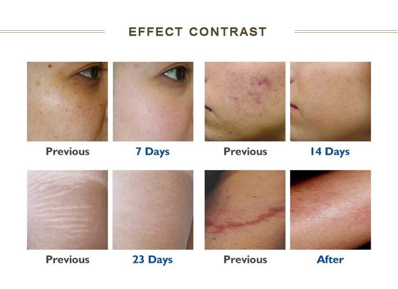Resurfacing CO2 Fractional Laser Machine 10600nm Uneven Skin Tone Fix