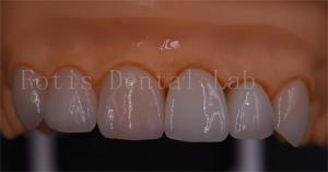 China 3 Shape Digital Crowns Good Compatibility Dentrues Design 1 Day Delivery wholesale