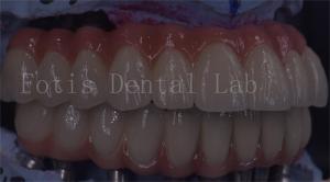 China OEM Service Durable Dental Implant Temporary Crown Easy Maintenance wholesale