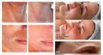 Beauty Salon Ultrasound Treatment Machine LDM Facial Skin Tightening