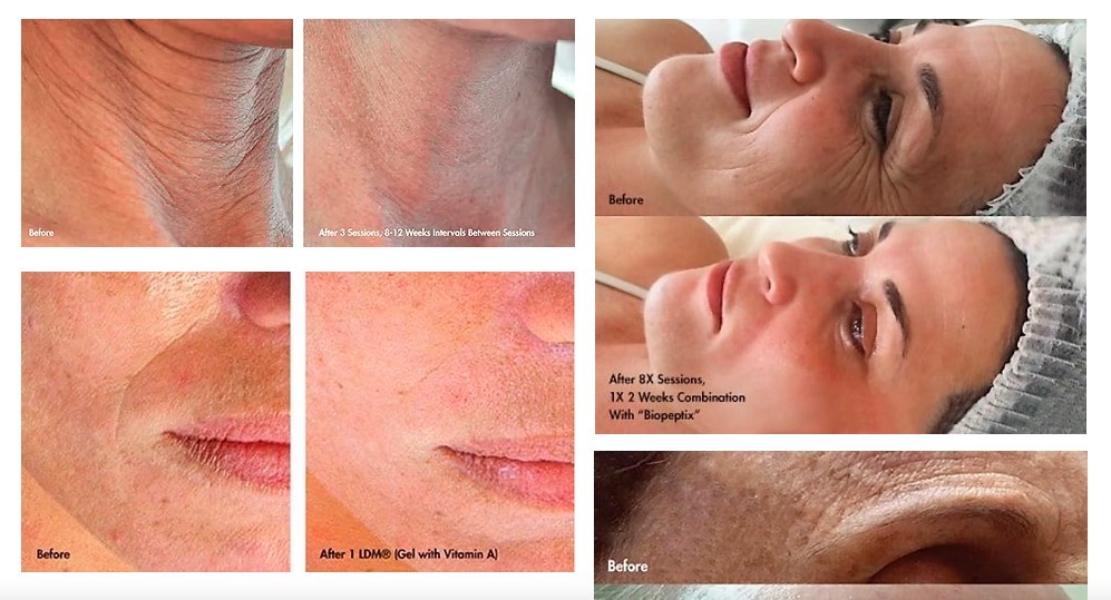 LDM Ultrasound Skin Rejuvenation Machine Low Frequency Dual Frequency