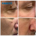 Fractional Laser Equipment 110V 220V Laser Acne Scar Removal Machine Spot Size 0