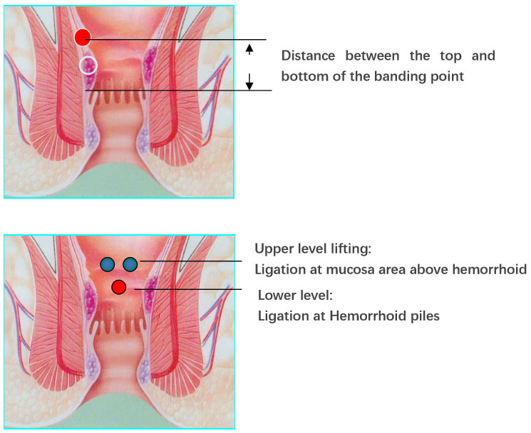 Automatic Hemorrhoid Removal Without Surgery , Internal Piles Treatment Curved Intraluminal Stapler
