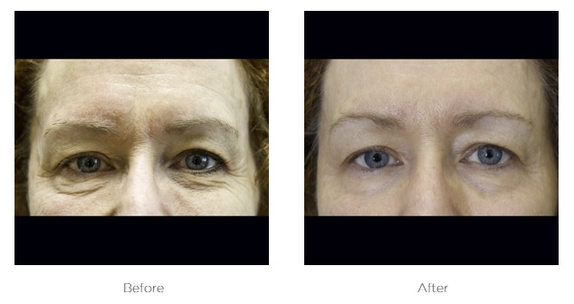 Elite Ultra 360_Before_and_After_photos_Eyes