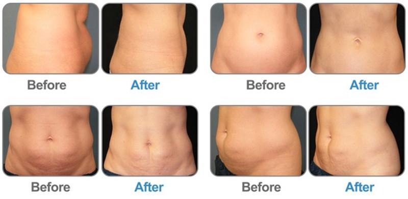 100V Four Applicators Cryolipolysis Fat Freeze Slimming Machine