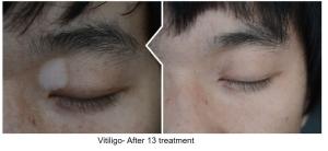 China CFDA 308NM Excimer System Laser Vitiligo Machine XeCl 140s Treatment wholesale