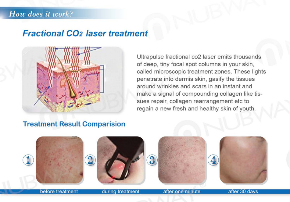 Fractional co2 laser for skin renewing CO2 fractional laser machine with newest technolog