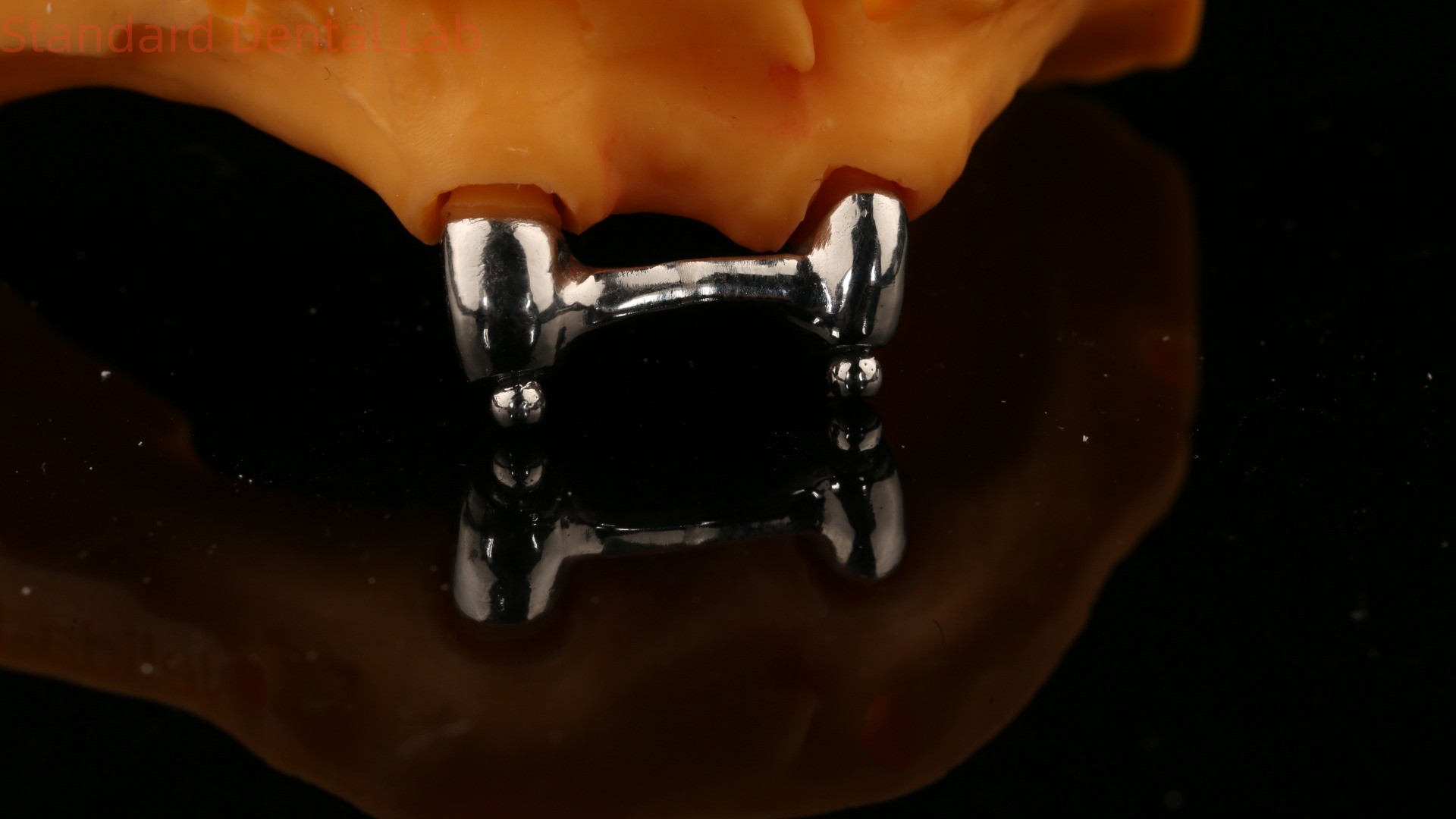 Ivoclar Digital Dental Implant Bar Denture with Attachments , Full Acrylic Titanium Implant Supported Dentures