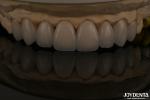 Feldspathic Natural Looking Cosmetic Veneers Precise Fit Highly Translucent