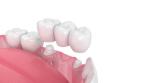 Porcelain Dental Crown Acid And Alkali Resistance Good Biocompatibility