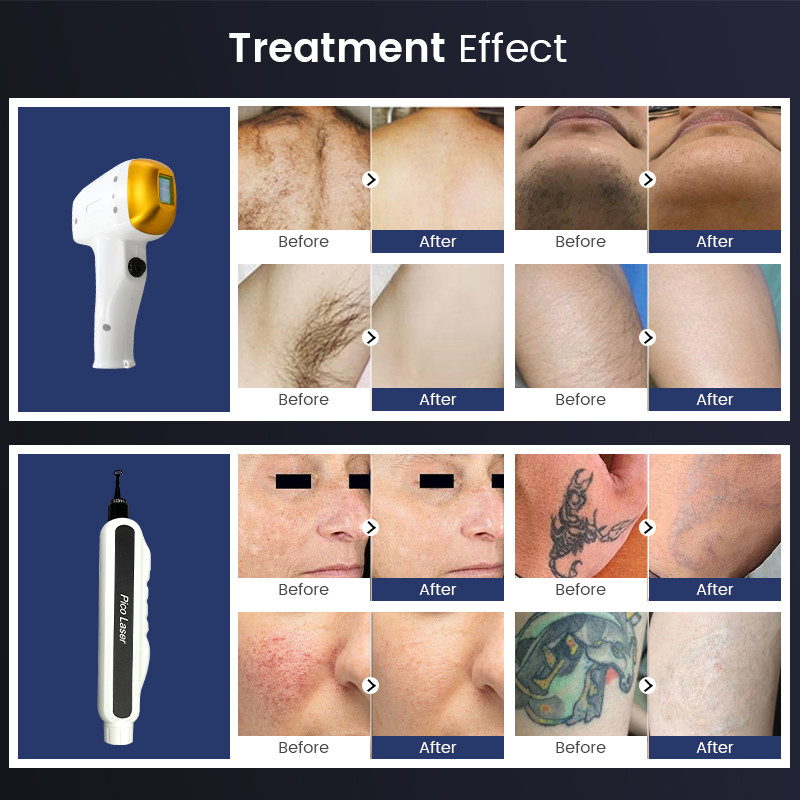 220v 808nm Diode Laser Hair Removal Machine 2 In 1