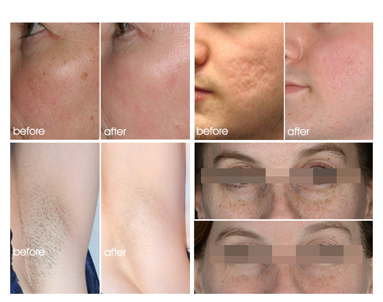Salon Beauty IPL Laser Permanent Hair Removal Machine For Commercial