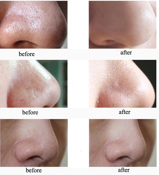 Acne Removal 3.7V DC Pore Suction Vacuum Blackhead Remover