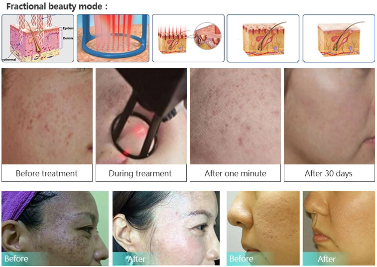 Medical CO2 Fractional Lasers RF Fractional CO2 Laser for sale