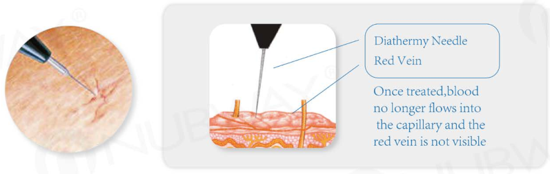 Clinical medical laser varicose veins laser treatment NBW-V600