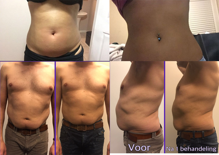 Customized most popular efficient spider veins removal varicose treatments for pigmented lesion