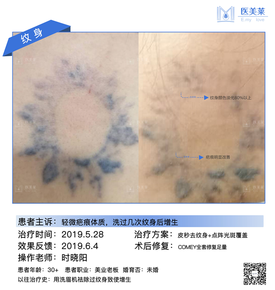 1064nm 2-10mm continuously adjustable  Spot  Pigmentation eraser Removal  Picosecond Laser Machine 9