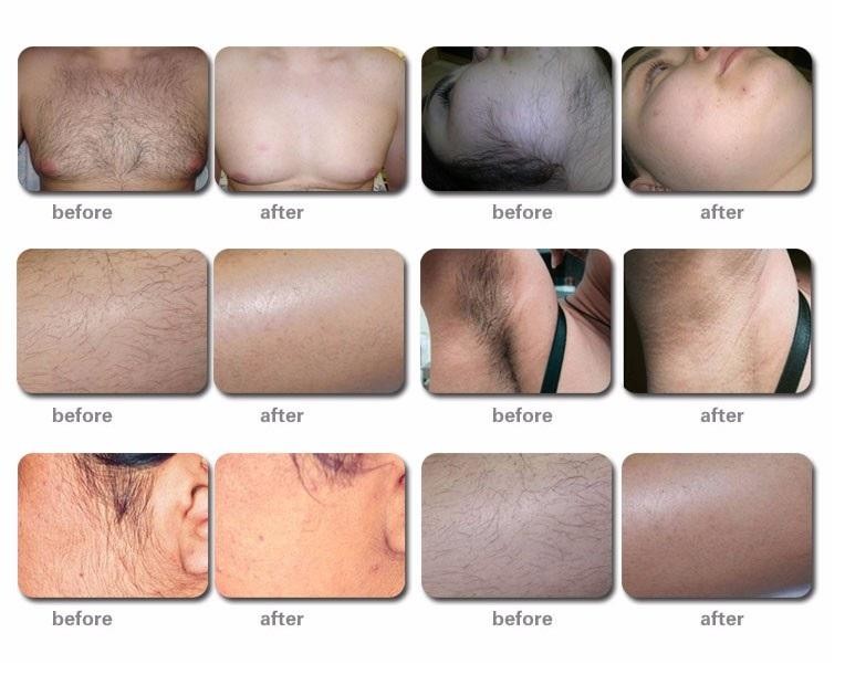 480-950nm Depilacion Painless Laser Hair Removal Machine For Eyelid Lifting