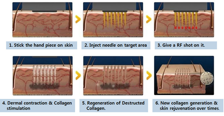 Fractional radiofrequency micro needling skin maintenance microneedle nurse system