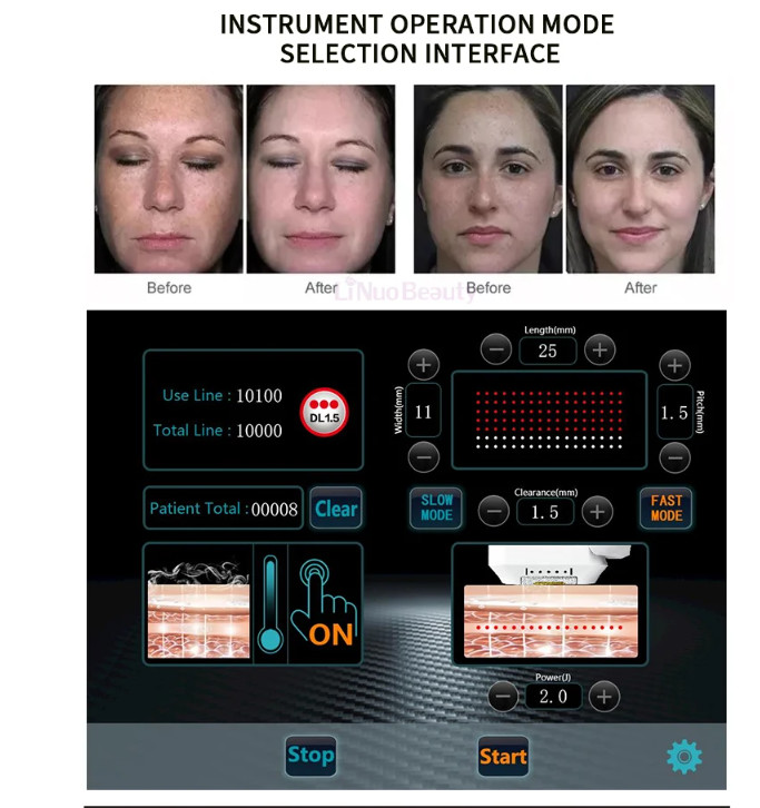 12D CRYOHIFU Hifu Skin Tightening Machine Face Lifting Machine Focused Ultrasound Hifu