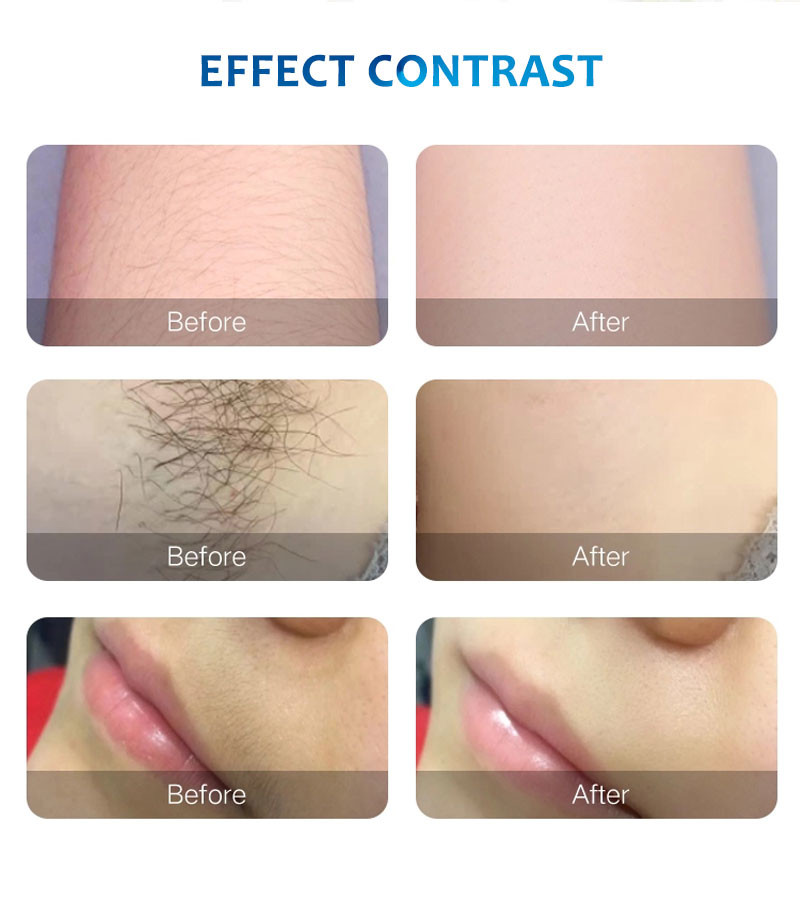 Triple Wave Face Hair Removal For Women At Home 10-120J/cm2 Collimated Beam
