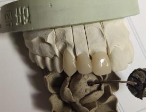 China CAD Technique ISO13485 Interim Crown wholesale