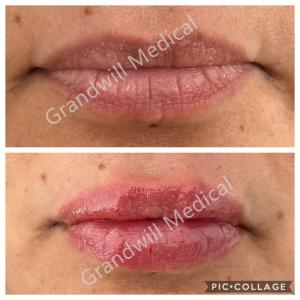 China Lip Augmentation Injectable Hyaluronic Acid Gel Dermal Filler 1ml 2ml wholesale