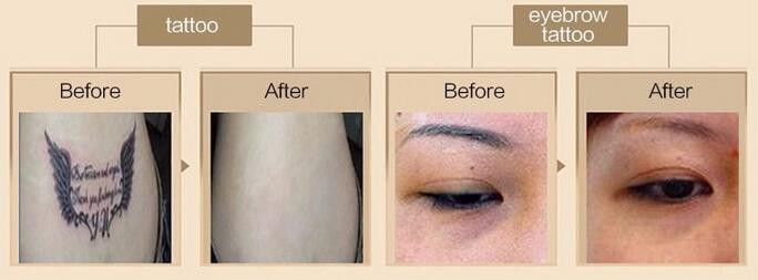 Picosecond q switched nd yag laser picosure q-switched tattoo removal laser machine
