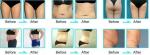 2015 new technology cryolipolysis radio frequency for fat reduction